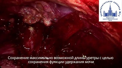 Рак предстательной железы: лапароскопическая радикальная простатэктомия